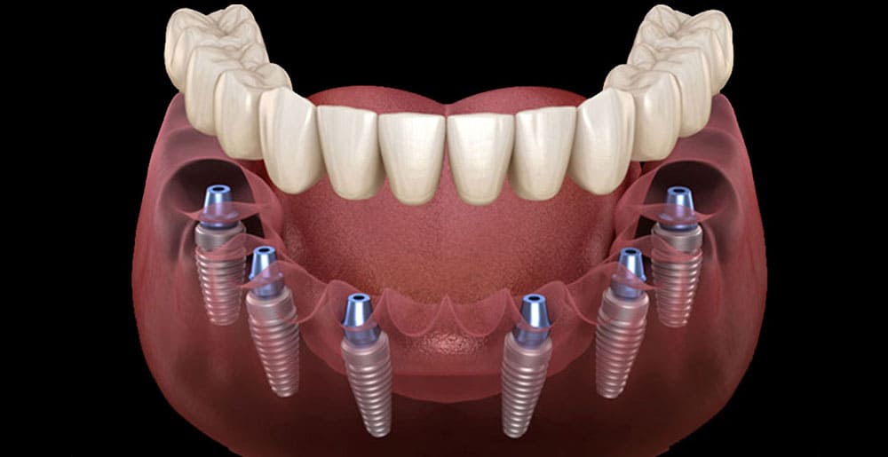 All-on-6 Dental Implants
