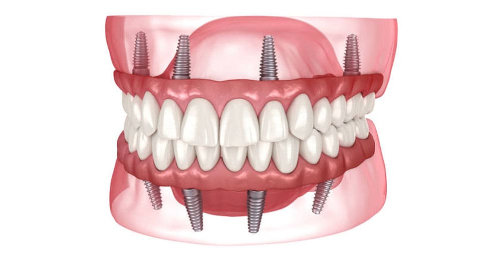 Full Mouth Implants