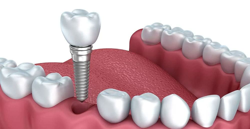 Single Tooth Implant
