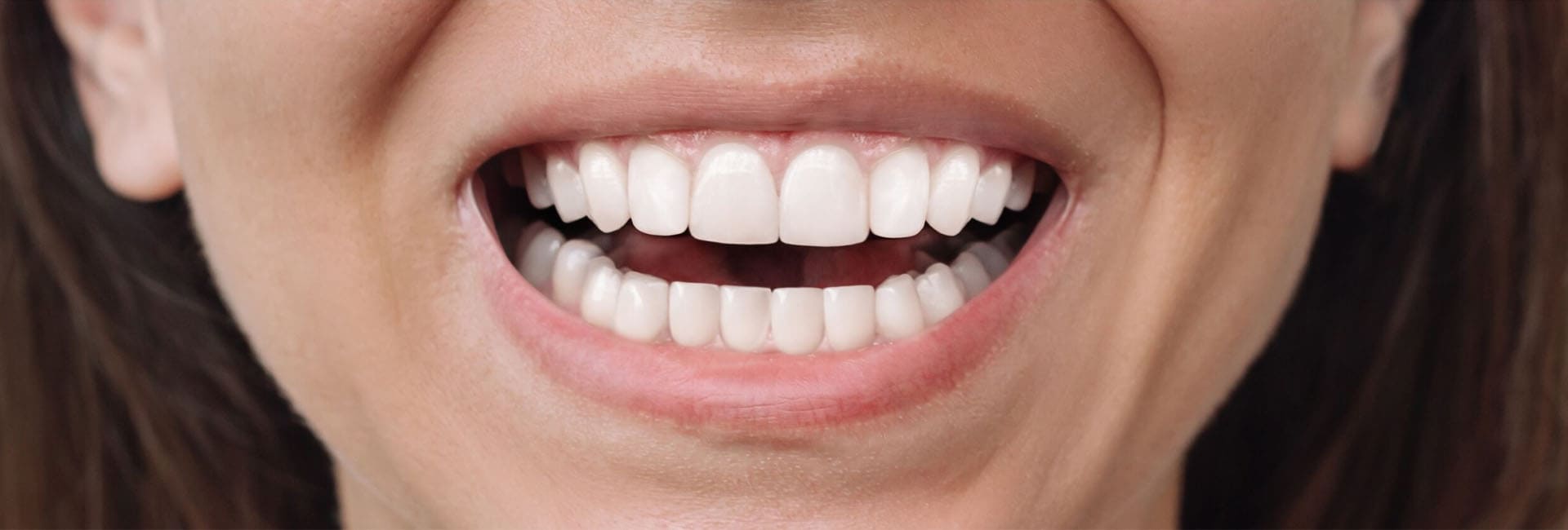 Invisalign After Image