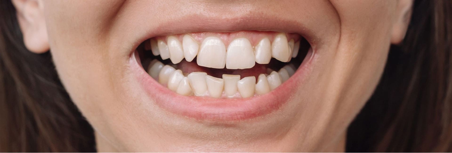 Invisalign Before Image