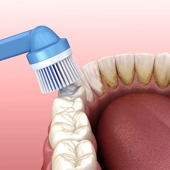 teeth-cleaning-lucknow