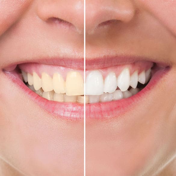 teeth-whitening