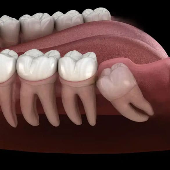 teeth-cleaning-lucknow