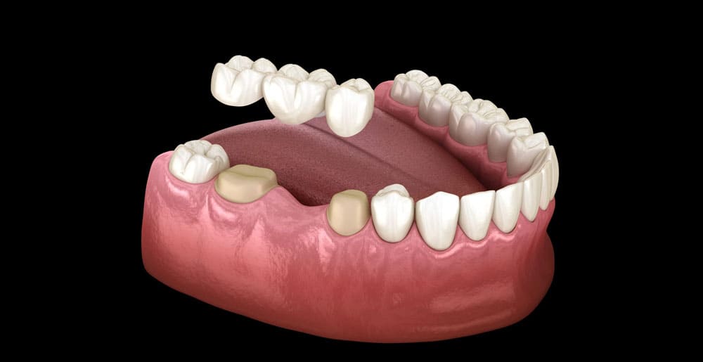 Dental Crowns & Bridges