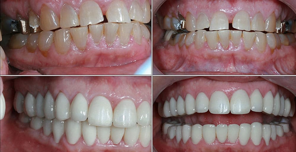 full-mouth-rehabilitation