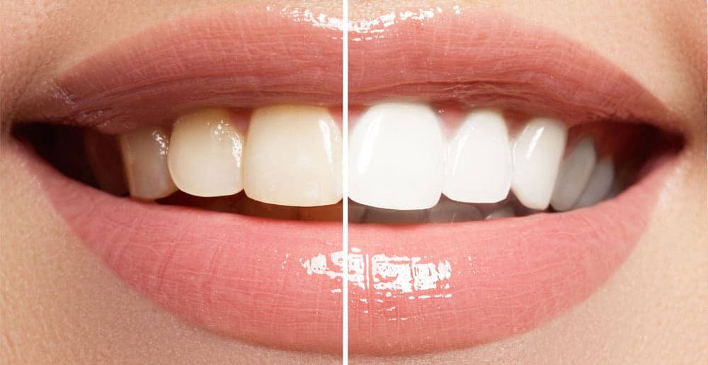 Teeth Whitening